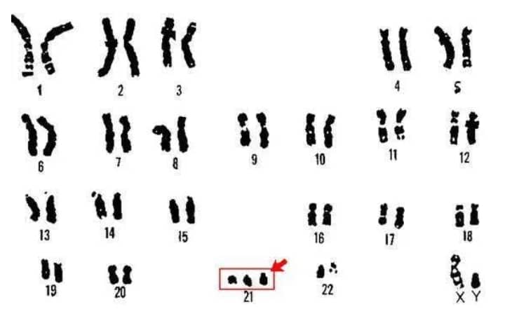 代怀男孩-多发子宫肌瘤可以人工授精？多发子宫肌瘤可以做试管吗？