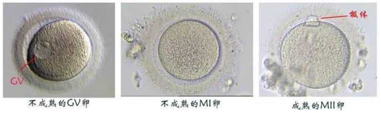 代怀男孩-孕早期宫腔积液怎么排出
