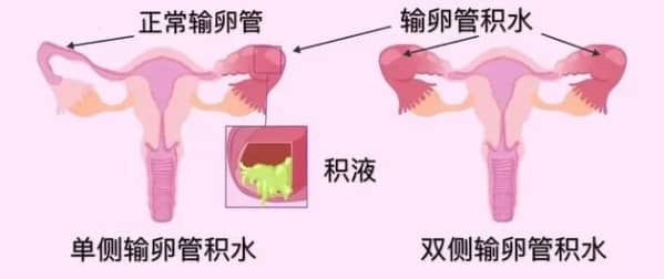 右卵巢囊肿手术多久可以备孕?右侧卵巢囊肿手术?
