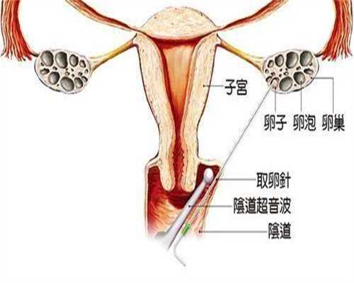 舟山拉拉腹腔镜检查不孕：三代试管圆你生育梦
