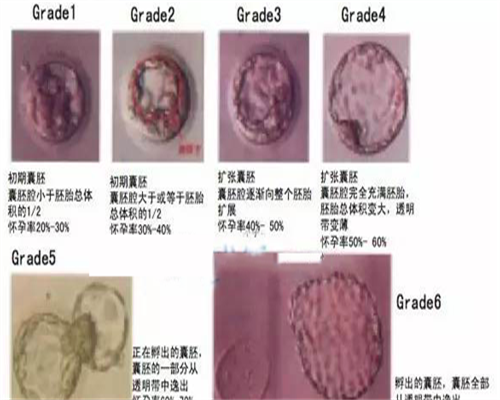 舟山单身女性子宫内膜厚不孕？三代试管+代怀选性别全攻略