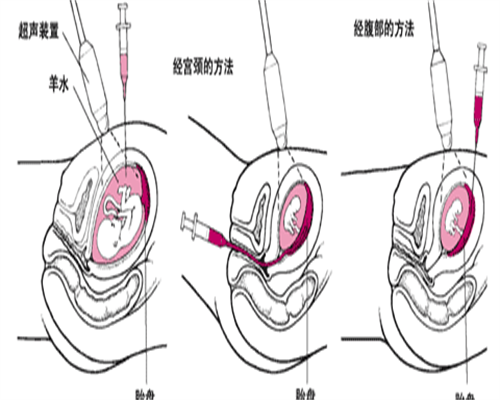 深圳单身女性高泌乳素血症不育，供卵三代试管选性别助好孕