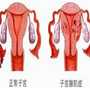 广州拉拉必看：输卵管通而不畅不孕，代生供卵三代试管全攻略